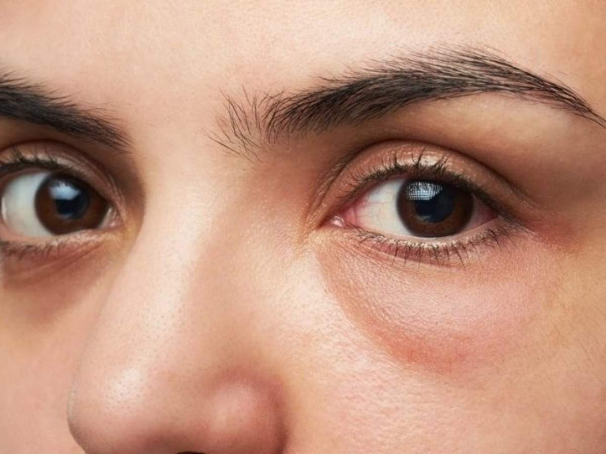 4 super tips to fix puffy eyes - Times of India