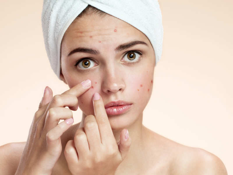 Teen Acne (Pimples): How to Get Rid of Teen Acne | Acne Treatment for  Teens: Boys & Girls