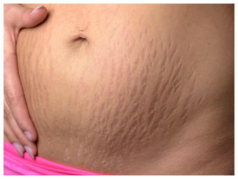 Stretch Marks Understanding Pregnancy Stretch Marks Times Of India