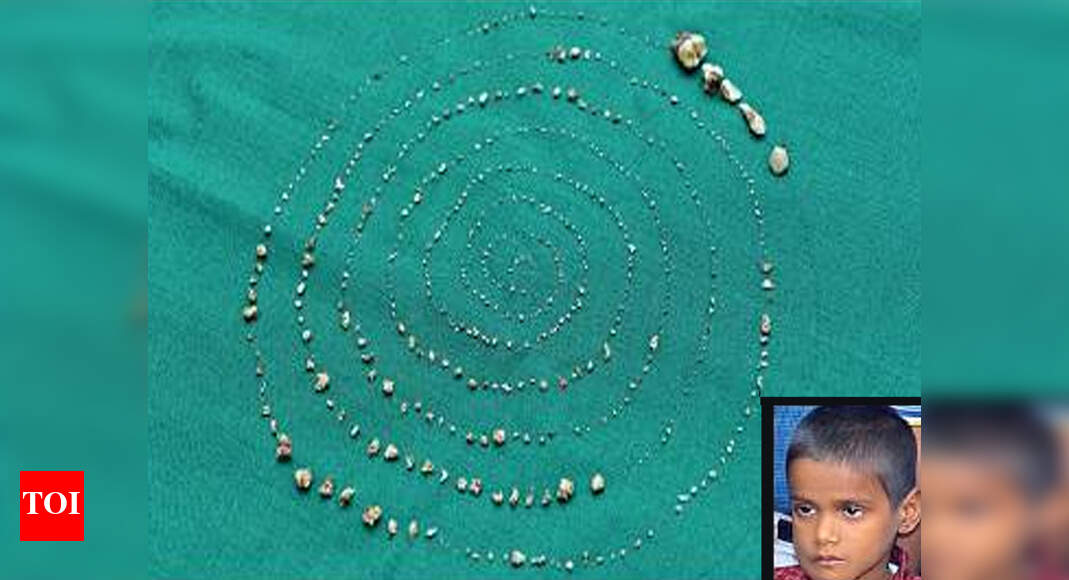 Chennai boy loses 526 teeth, gets his smile back | Chennai News - Times ...