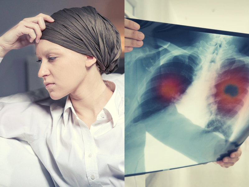 28-year-old non-smoker Delhi woman diagnosed with stage 4 lung cancer due to air pollution