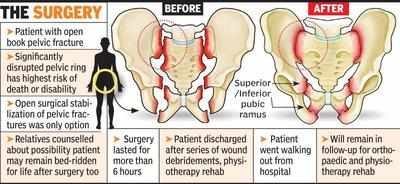 What are open book pelvic fractures?