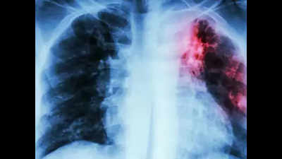 Thane: No hospital beds for XDR-TB patients to start new drug