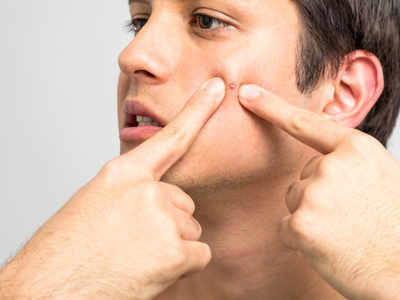 3 ways to get rid of a pimple fast