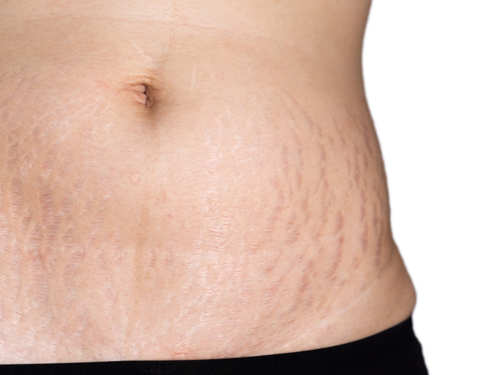 How can you prevent stretch marks while losing weight? | The Times of India