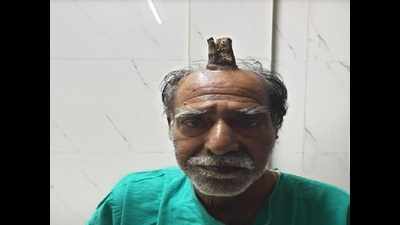 For 5 years, Sagar man carried 4-inch 'horn', removed after surgery