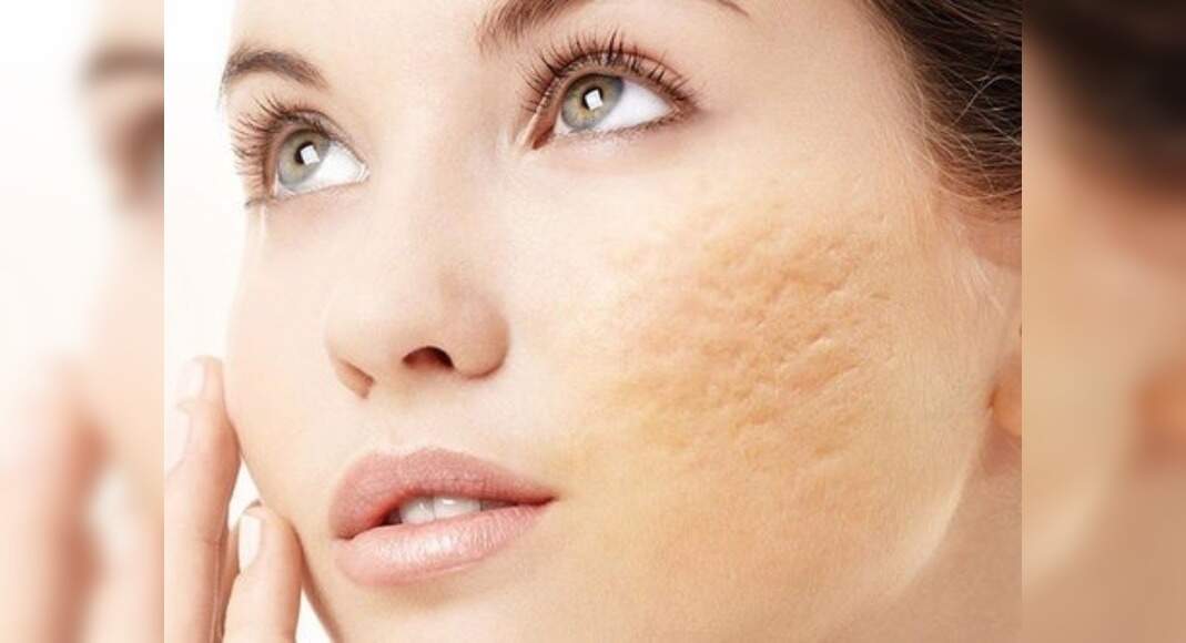 Natural remedies that you can use to treat chickenpox scars - Misskyra.com
