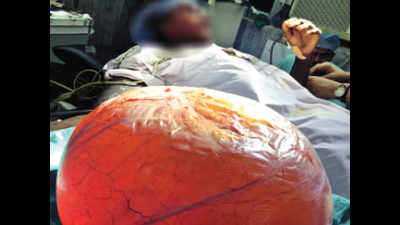 Wardha doctors remove pumpkin-sized ovarian cyst of 38-year-old patient