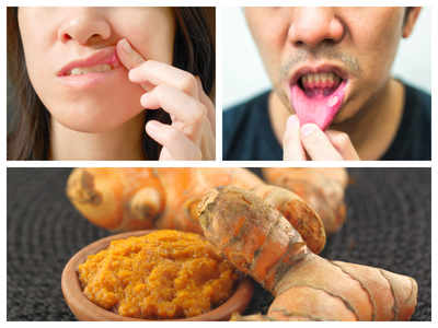 What are mouth ulcers? How turmeric helps in treating mouth ulcers