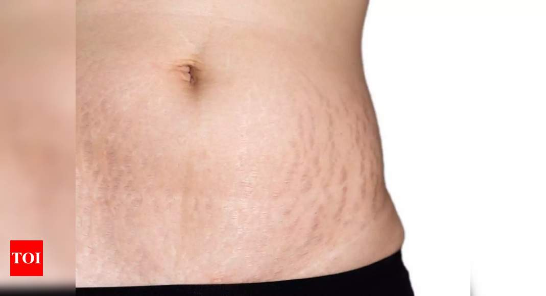 Belly Mask for Stretch Mark Treatment