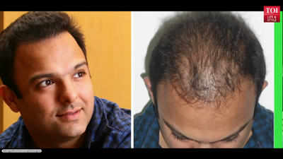 10 Celebrities With Hair Transplant  Before  After 