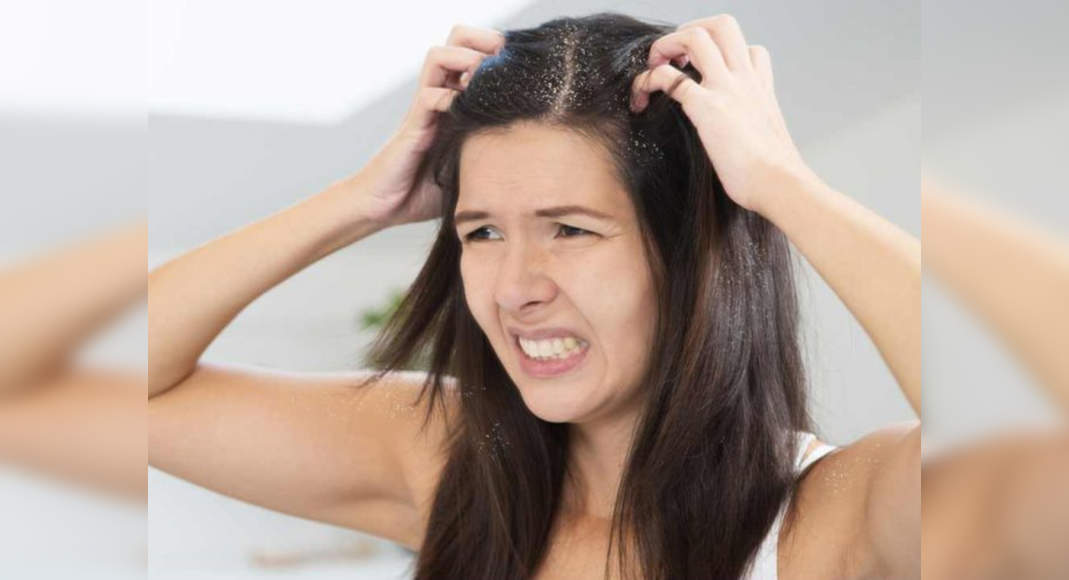 Oiling is not the solution to get rid of dandruff issues - Misskyra.com