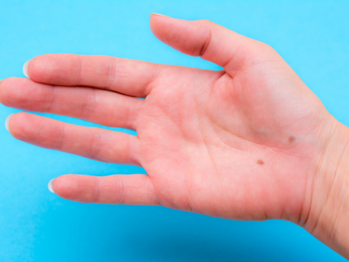 If you have moles on these 9 body parts, you are really lucky! | The Times of India If you have moles on these 9 body parts, you are really lucky! | The Times of India