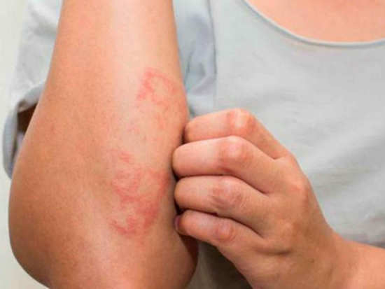 Some easy home remedies to cure psoriasis
