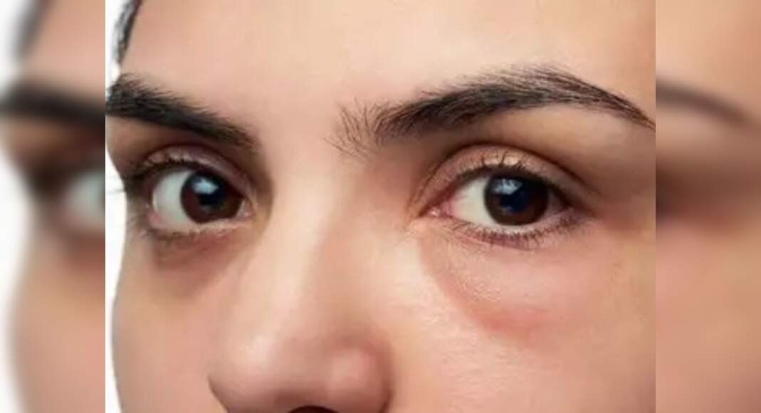 Ways in which you can get rid of those puffy eyes! - Misskyra.com