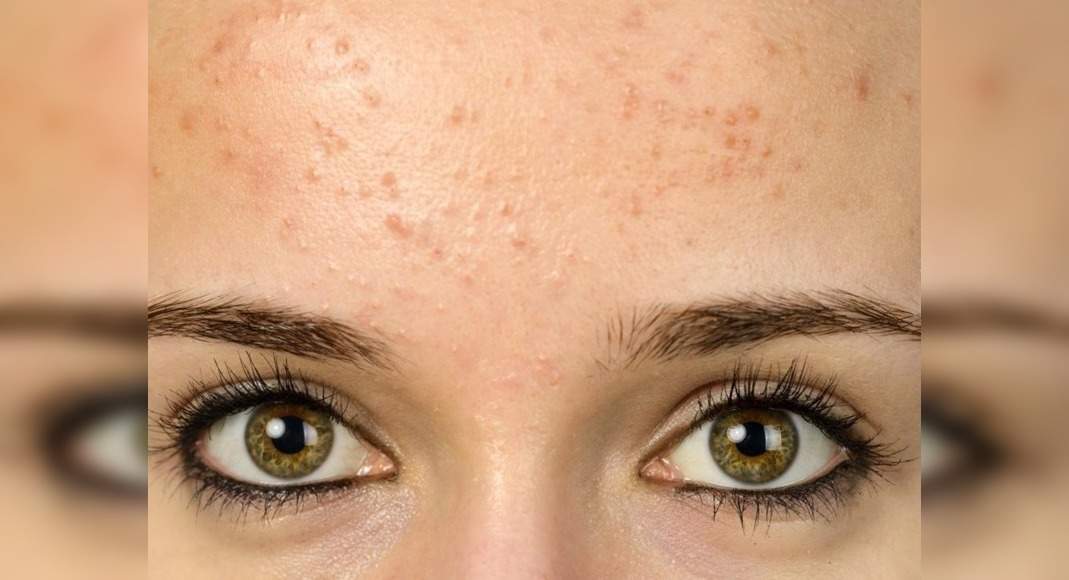 Causes of acne on your forehead - Misskyra.com