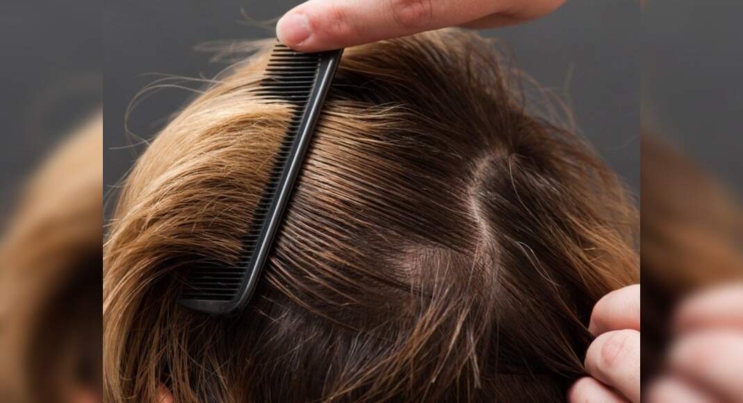 Best Hacks To Fix Greasy Hair Quickly