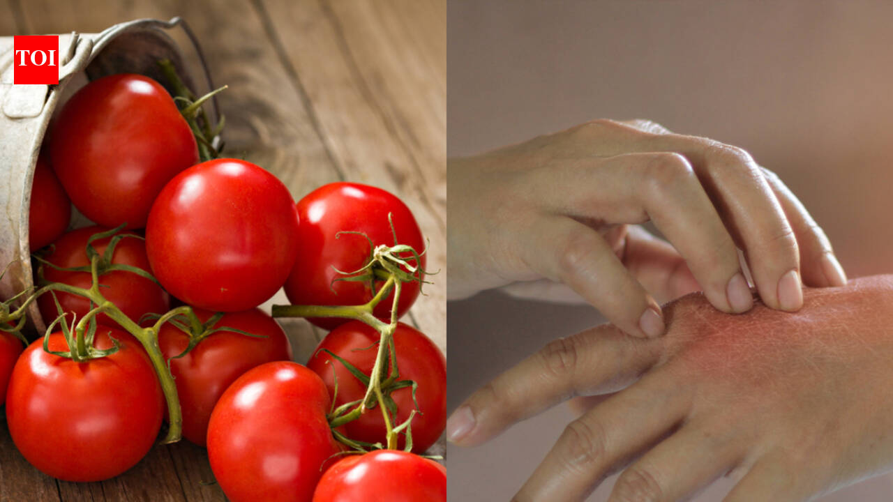 Can eating tomatoes flare up your Psoriasis?
