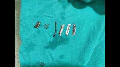 Dehradun: Doctors remove razor blades, iron nails and hair pins from man’s abdomen