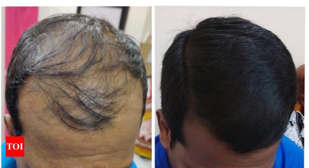 One male hair loss treatment works better than others study finds  CNN