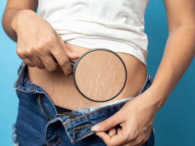 Easiest ways to hide STRETCH marks