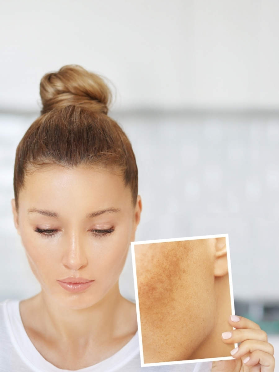 How to get rid of dark spots on black skin