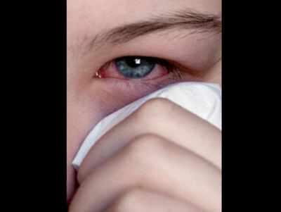 Sore eyes common vision-based indicator of Covid-19, study finds