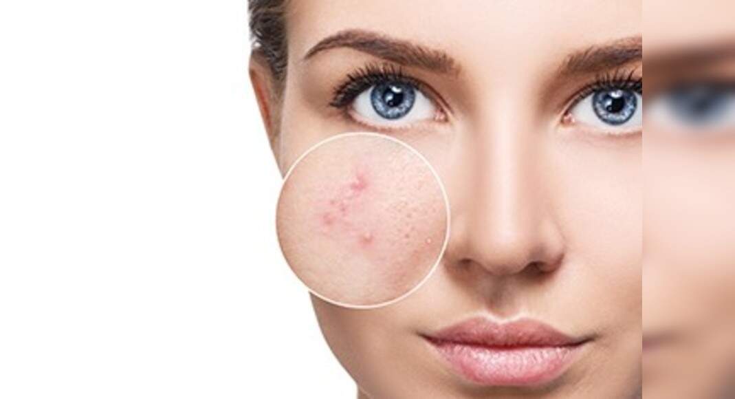 Natural remedies for period acne