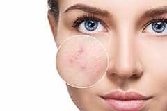 Natural remedies for period acne