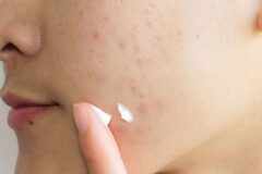Easy ways to get rid of acne scars once and for all!