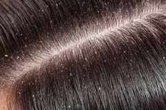 Home remedies that will get rid of dandruff in a jiffy