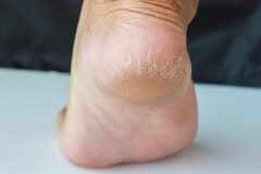 Natural remedies for cracked heels