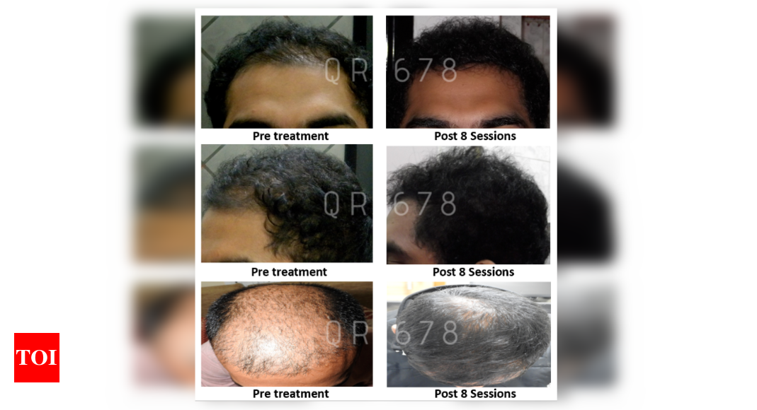 Hair Transplant Before and After  Dr Amit Gupta Plastic Surgeon In Delhi   Gurgaon India