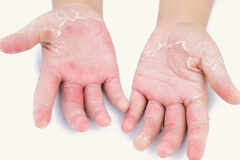 These remedies for peeling skin will work wonders