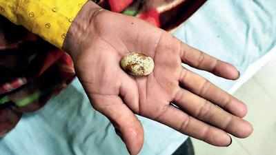26 mm stone removed from 3-yr-old rescued beggar girl