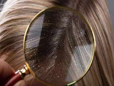 Anti-dandruff conditioner: Say no to flaky, and itchy scalp
