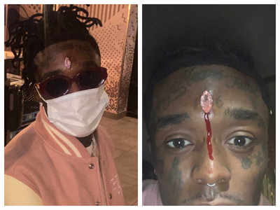 Rapper Lil Uzi Vert gets USD 24 million diamond implant on forehead