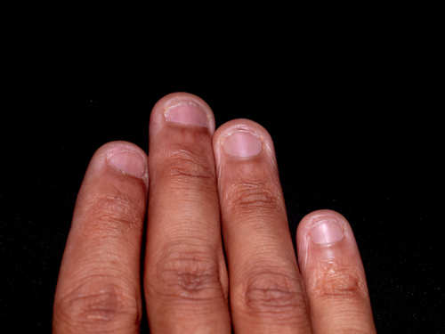The science behind why you bite your nails and easy ways you can stop | The  Times of India