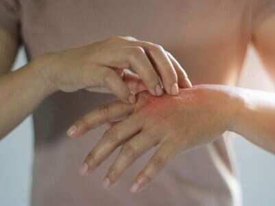 Skin rashes can be a sign of COVID-19