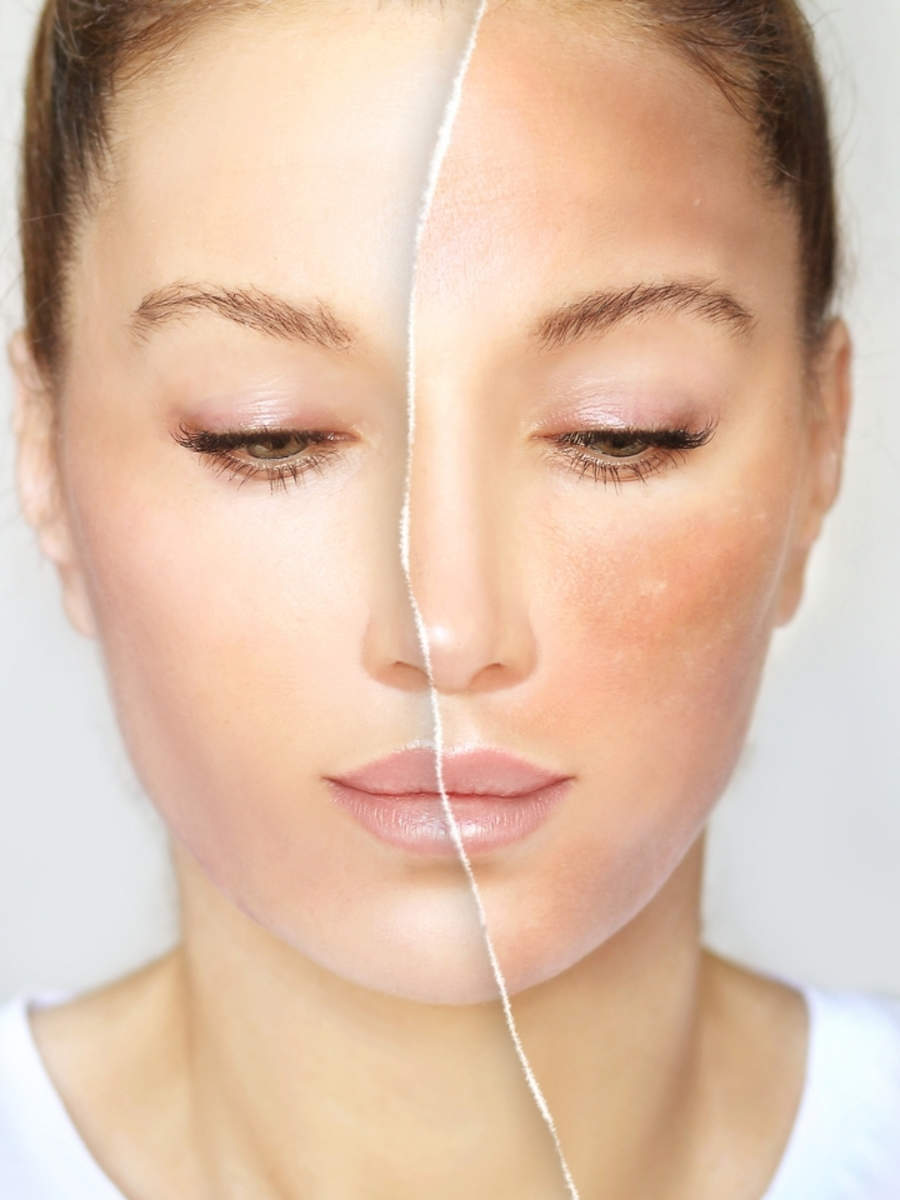 how-to-get-rid-of-dark-spots-times-of-india