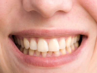 3 Grandma approved home remedies to whiten yellow teeth