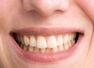 3 Grandma approved home remedies to whiten yellow teeth