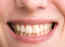 3 Grandma approved home remedies to whiten yellow teeth