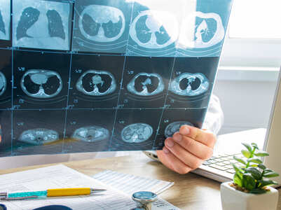 Frequent CT scan can increase the risk of cancer
