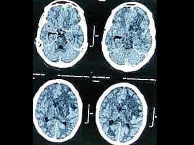 Mucormycosis found in 23-year-old Covid-cured Surat patient’s brain