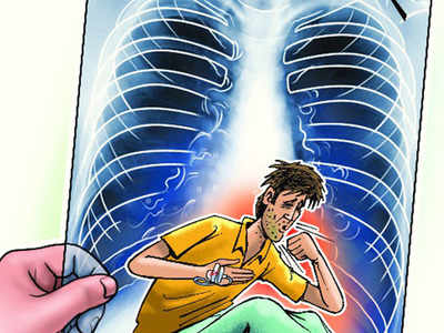 12-17% multi-drug resistant tuberculosis cases seen in Goa yearly