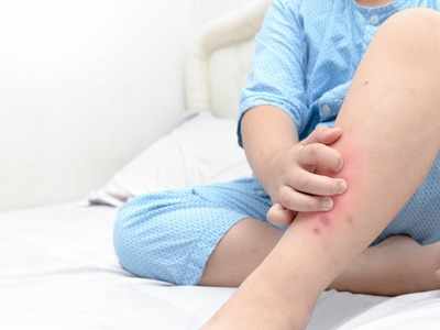 Coronavirus: Skin symptoms that could be signs of the dreaded MIS-C in kids