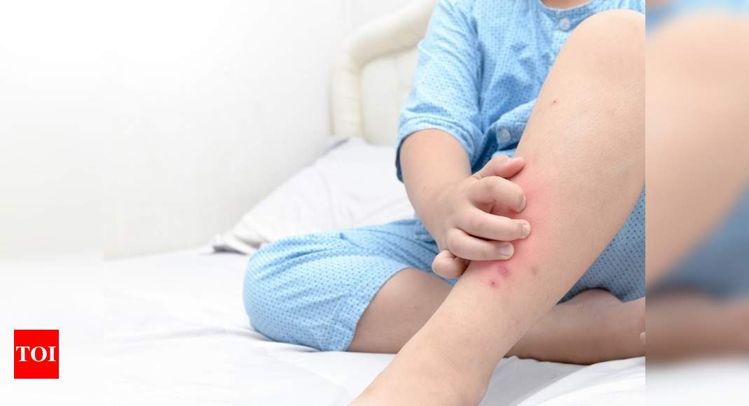 Coronavirus Symptoms In Kids Skin Symptoms That Could Be Signs Of The Dreaded Mis C In Kids