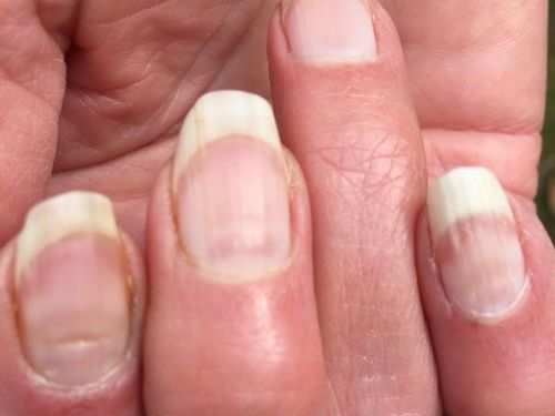 Coroanvirus Symptoms Covid Nails Could Be A Sign That You Have Had Covid Here S How To Identify It