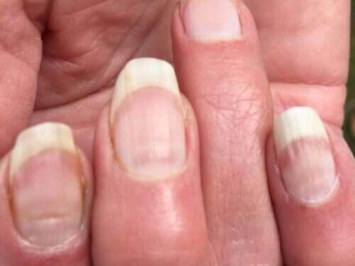 Coroanvirus Symptoms Covid Nails Could Be A Sign That You Have Had Covid Here S How To Identify It Coroanvirus Symptoms Covid Nails Could Be A Sign That You Have Had Covid Here S How To Identify It